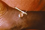 guinea worm.jpg