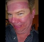 Sunburn.jpg
