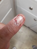 Thumb nail damage 2-22-2024.jpg